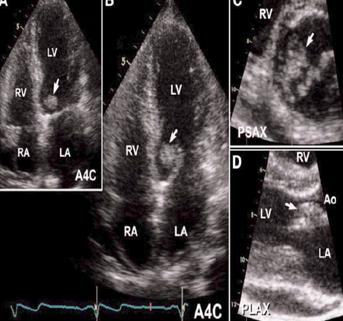 <p>valves are exposed to high velocity regurgitant jets&nbsp;</p><ul><li><p>LV side of AV</p></li><li><p>LA side of MV</p></li></ul><p>(mv vegetation on LV side which is not usual )</p>