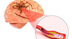 <p><strong>After surviving an ischemic stroke, a 79-year-old male has demonstrated significant changes in his emotional behavior, with his family noting that he now experiences wide mood swings with exaggerated responses of empathy, anger, and sadness to situations. His care team would most likely attribute these responses to ischemic changes in which of the following brain structures?</strong></p><p>A) The man's occipital lobe</p><p>B) The client's temporal lobe in general and Wernicke area in particular</p><p>C) The man's parietal lobe</p><p>D) The components of the client's limbic system</p>