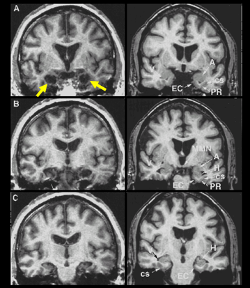<p>had severe intractable epilepsy that did not respond to medication so had surgery to remove his bilateral medial temporal lobes (where they thought the seizures came from)</p><ul><li><p>structures removed include hippocampus, entorhinal cortex, amygdala - these regions give context to the memories we want to create</p></li></ul><p>he now had anterograde amnesia and couldn’t form new memories but personality didn’t change and ability to learn new information of certain kinds stayed, just not autobiographical</p><p>also had some retrograde amnesia</p>