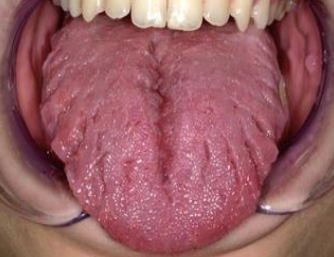 <p>A cleft or groove, normal or otherwise, showing prominent depth</p>
