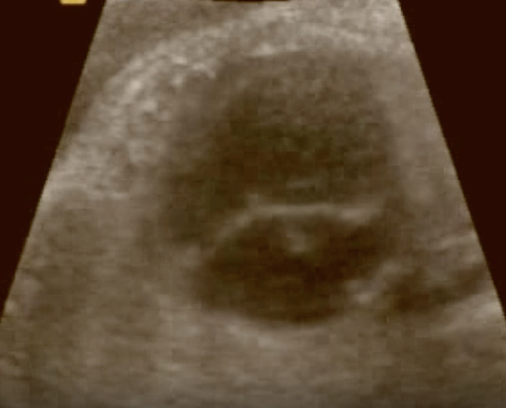 <p>the findings are </p><p>a) hypoplasia left heart</p><p>b) normal 4 chamber heart</p><p>c) atrioventricular septal defect</p><p>d) tetralogy of fallot</p>