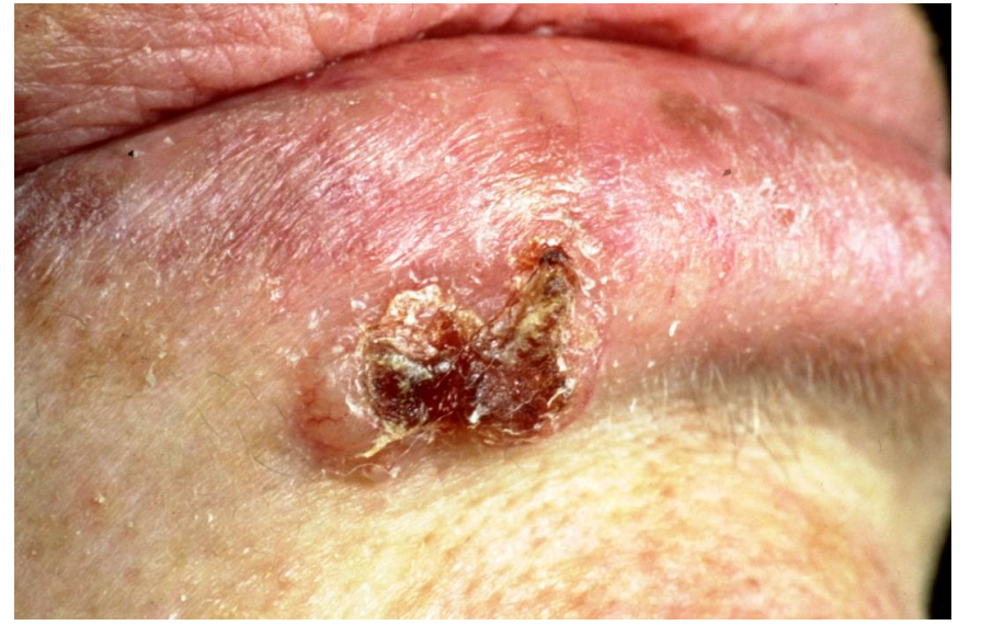 <ul><li><p>ulcer</p></li><li><p><em>This patient has an ulcerated nodular basal cell carcinoma</em></p></li><li><p><em>raised margin, looks see through (opalescent)</em></p></li></ul><p></p>