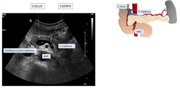 <ul><li><p>Páncreas que rodea el vaso que es la confluencia entre vena porta y esplénica</p></li></ul><p></p>