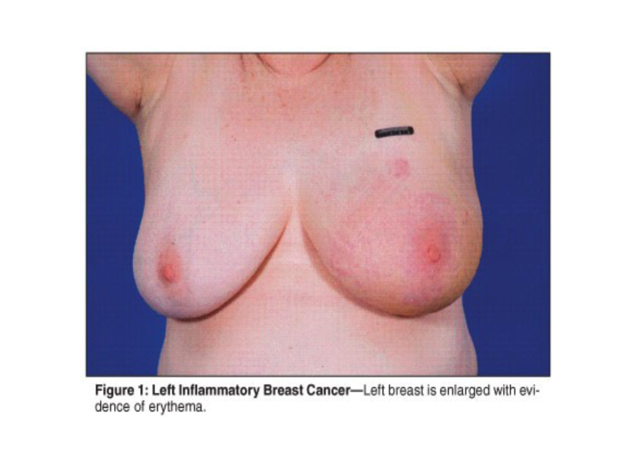 <p>inflammatory breast cancer</p>