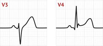 <p>ST elevation </p>