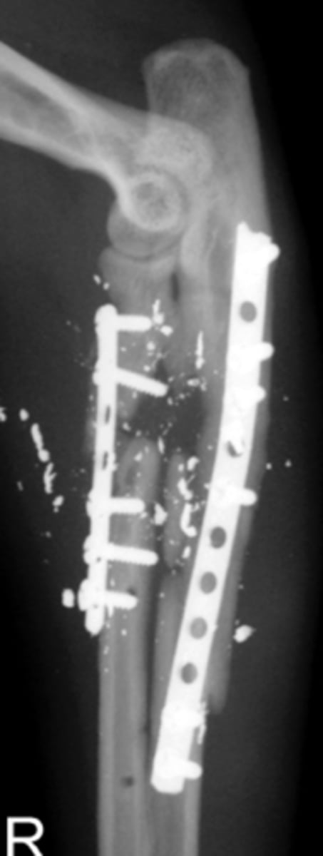 <p>What is this an example of given that the radiograph was taken 4 weeks post fracture?</p>