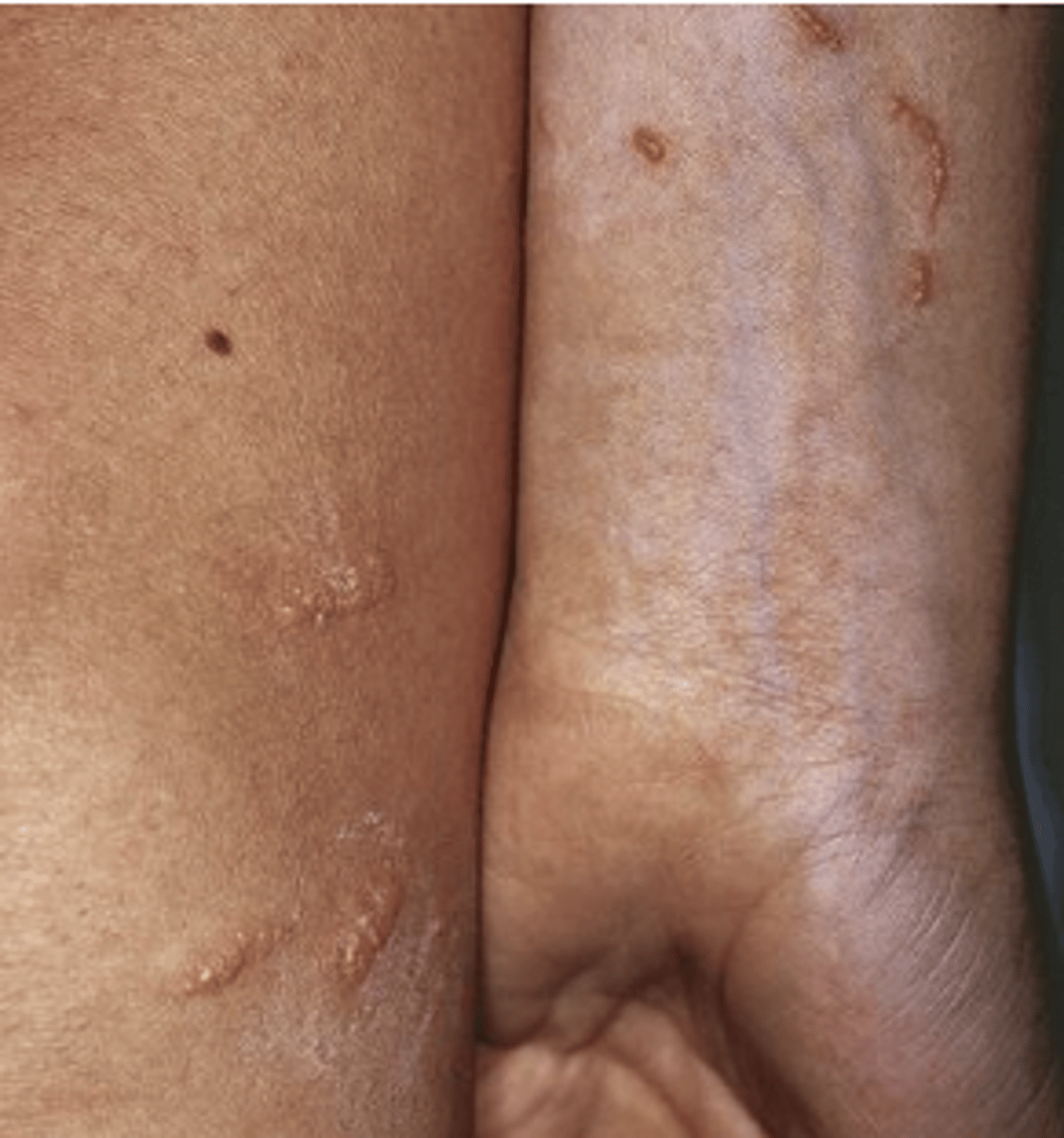 <p>Acute or chronic skin inflammation caused by exposure to an external agent</p><p>- Priutitis, erythema, edema</p><p>- Removal of offending agent for management</p>