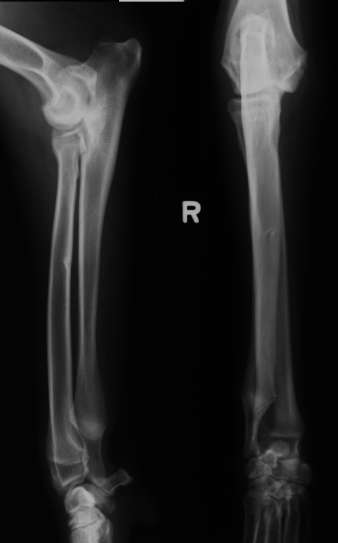 <p>which physis closed early</p>