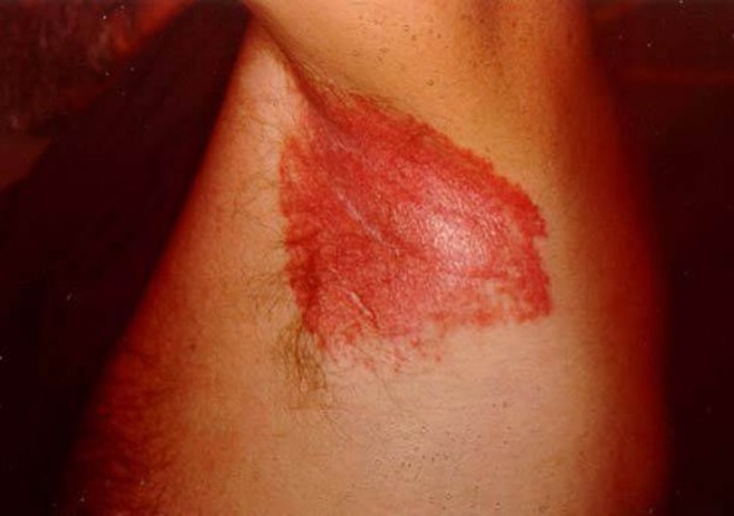<p>Inverse psoriasis</p>