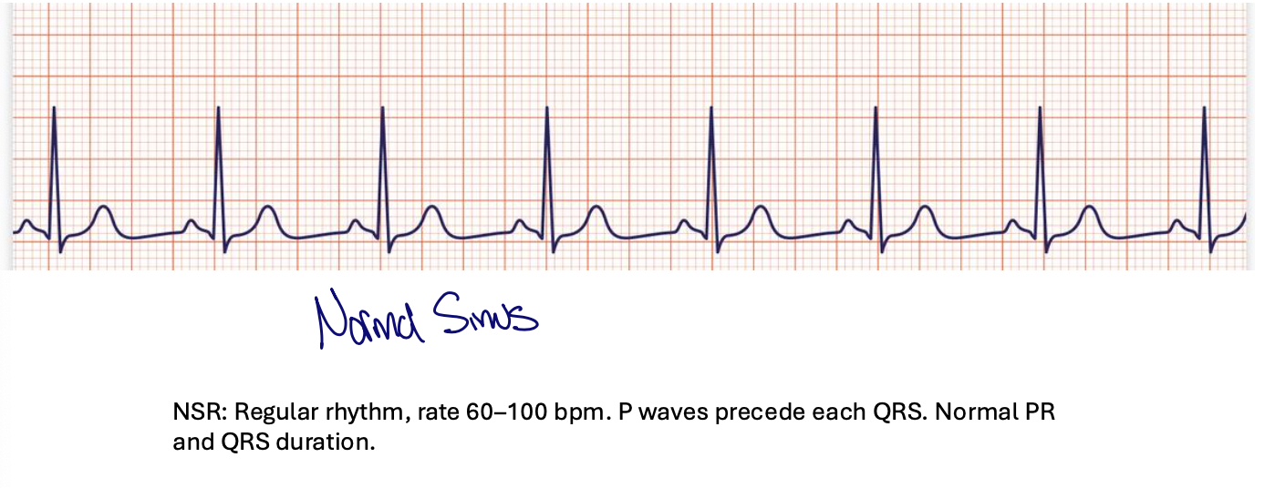<p>reugular rythym&nbsp;</p><p>rate: 60-100 bpm</p><p>p waves procede eachh QRS&nbsp;</p><p>normal PR and QRS</p>