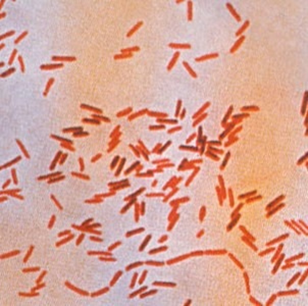 <p>Identify Pathogen causing Diarrhea:</p><p>Gram-negative rod, MOTILE (flagella), acid labile, facultative intraclelular</p><p>-Hx:</p><p>&gt; Reptiles (turtles)</p><p>&gt; Amphibians</p><p>&gt; Typhoid = Contaminated water or food</p><p>&gt; Undercooked meat/eggs/poultry</p><p>-Path: INVASIVE = spreads through blood and invades GI tract via M cells; only infectious at high doses</p><p>-Sx/PE:</p><p>&gt; Typhoid = (d/t typhi and paratyphi), starts 12-72 hrs after</p><p>&gt;&gt; FEVER</p><p>&gt;&gt; Abdominal Cramps</p><p>&gt;&gt; Rose colored spots on abdomen</p><p>&gt;&gt; Intestinal ulcers</p><p>&gt;&gt; Hepatosplenomegaly</p><p>&gt;&gt; Constipation --&gt; Diarrhea</p><p>&gt; Non-Typhoid = Foodborn Gastroenteritis (d/t enteritidis)</p><p>&gt;&gt; N/V</p><p>&gt;&gt; Watery --&gt; Blood stools</p><p>-Dx:</p><p>&gt; (+) Lactose = Green on EMB Agar</p><p>&gt; (+) H2S = Black on Hektoen enteric agar</p><p>&gt; Non-Typhoid/Foodborne Gastroenteritis = Intestinal ulceration &amp; hemorrhage, sometimes in Peyer's patches --&gt; </p><p>&gt; Typhoid = Dissemination of the organism from the Peyer’s patches occurs via the lymphatic system and the bloodstream --&gt; cellular replication within the reticuloendothelial system -&gt; systemic symptoms + Stored in gallbladder for chronic carriers (risk of GB Carcinoma)</p><p>-Tx: SELF-LIMITING, but supportive care + Rehydration (oral)</p><p>-Prog:</p><p>&gt; Reactive Arthritis (HLA-B27 +) if 20-40 y/o</p><p>&gt; UnTx (HUS) = delirium, obtundation, intestinal hemorrhage, bowel perforation, and death within 1 month of onset</p>