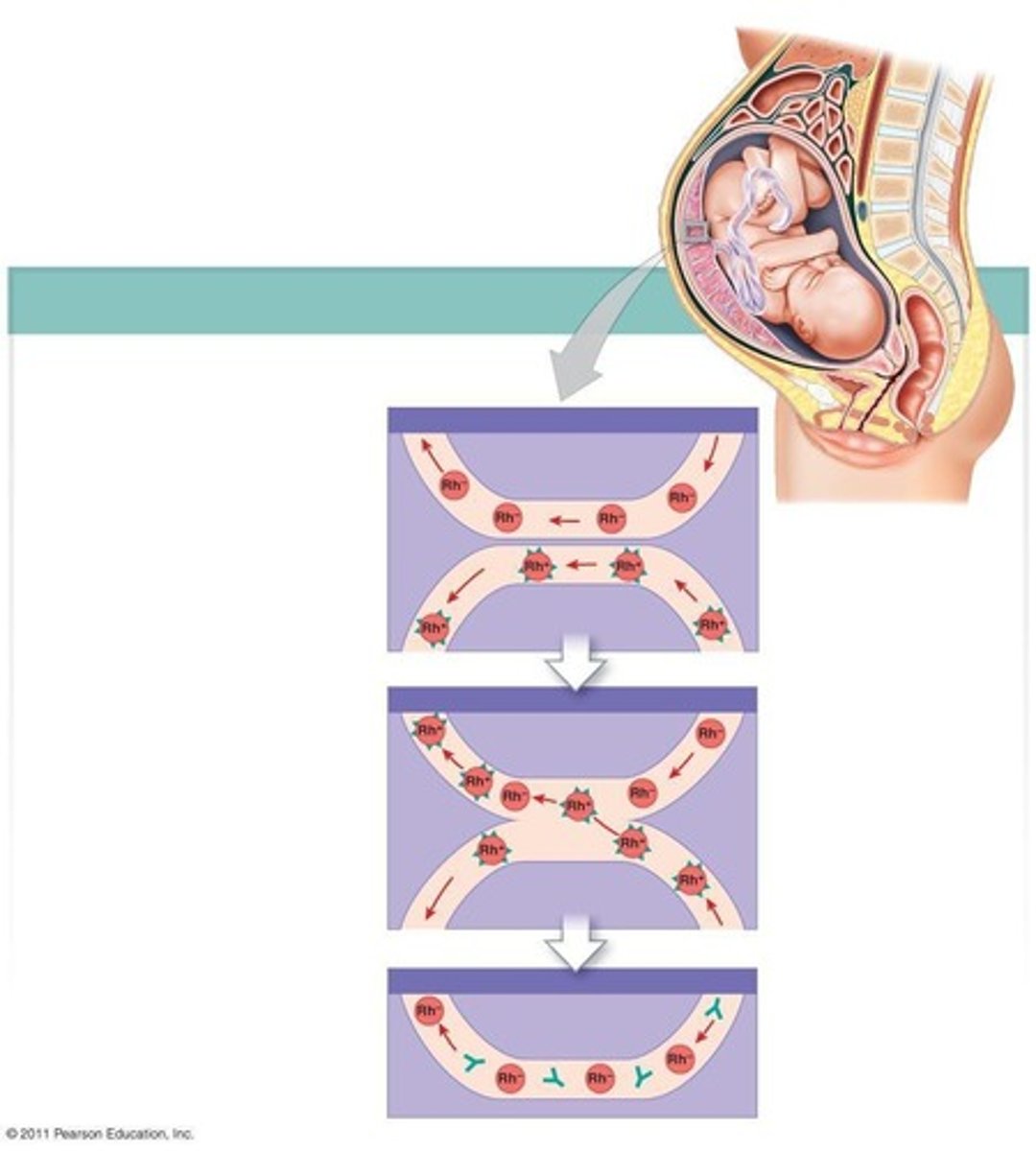 <p>A condition where a mother's antibodies attack fetal RBCs due to blood type incompatibility</p>
