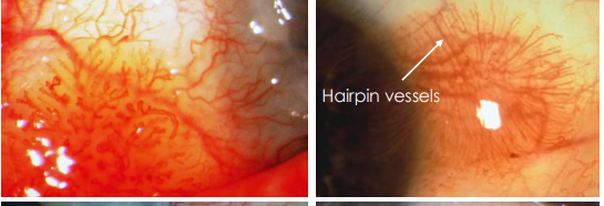 <p><strong><u>• Hairpin configuration of vessels around a sessile/flat lesion</u></strong></p>