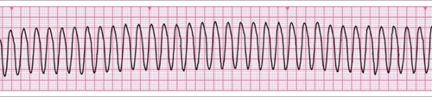 <p>Sleglahraðtakti (ventricular tachycardiu) og stuðar hann</p>