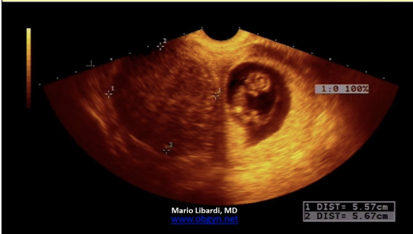 <p>what is the <strong>most common</strong> <strong><em>solid pelvic mass</em></strong> seen in pregnancy</p><p>.</p><p>a) thecoma</p><p>b) endometrioma</p><p>c) corpus luteum</p><p>d) fibroid</p>