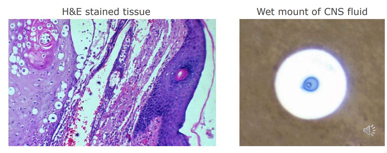 <p>Major virulence factor: <strong><u>capsule</u> is protective,</strong> prevents phagocytosis. <mark data-color="#a7ff91" style="background-color: rgb(167, 255, 145); color: inherit;">melanin is immunomodulatory</mark></p><p><mark data-color="#a7ff91" style="background-color: rgb(167, 255, 145); color: inherit;">capsuled microbes likely cause meningitis </mark></p>