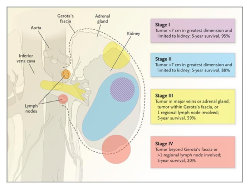 I: confined to renal capsule and <7cm
II: confined to renal capsule and >7cm
III: extends through renal capsule but not through fascia; renal vein, IVC, or regional nodal involvement
IV: extends through fascia or with distant metastasis