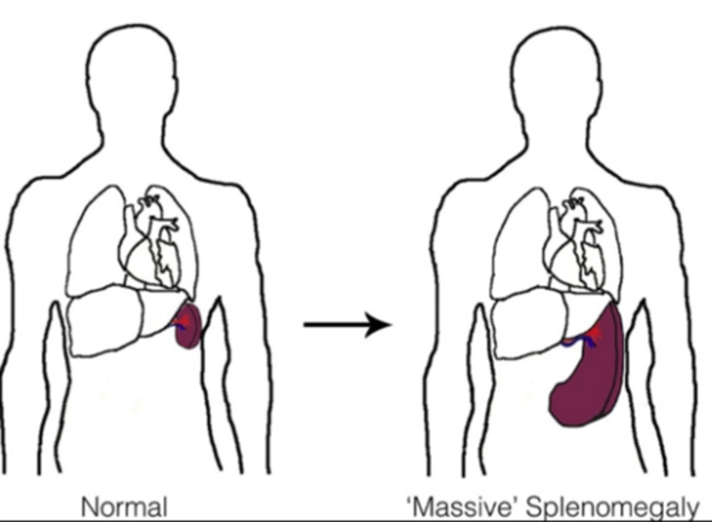 <p>What is Splenomegaly?</p>