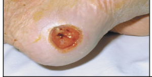 <p>Ulcer in the skin caused by epidermal and dermal breakdown; associated with constant pressure on the skin that decreases blood flow  \n over bony areas.</p>