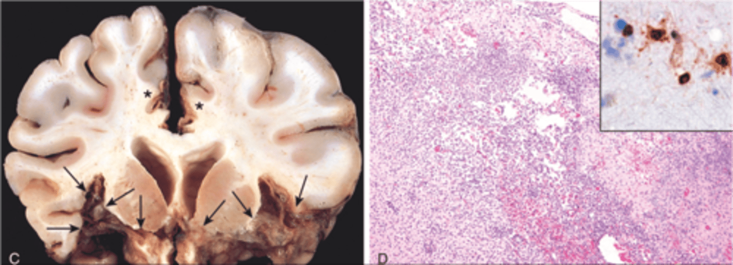 <p>Define Virus:</p><p>Viral Infection of meninges</p><p>Info:</p><p>-Seen in inferior bilateral temporal lobes (may see ring enhancing lesion)</p><p>-Necrosis</p><p>-Cowdry type A VIRAL inclusions (uninucleate cells)</p><p>-+PCR Test</p>
