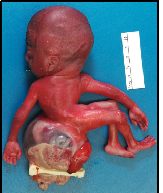 <ul><li><p>abnormal development of body folds leading to absence/shortening of umbilical cord</p></li><li><p>organs lie outside the abdominal cavity directly attached to the placenta</p></li></ul><p></p>
