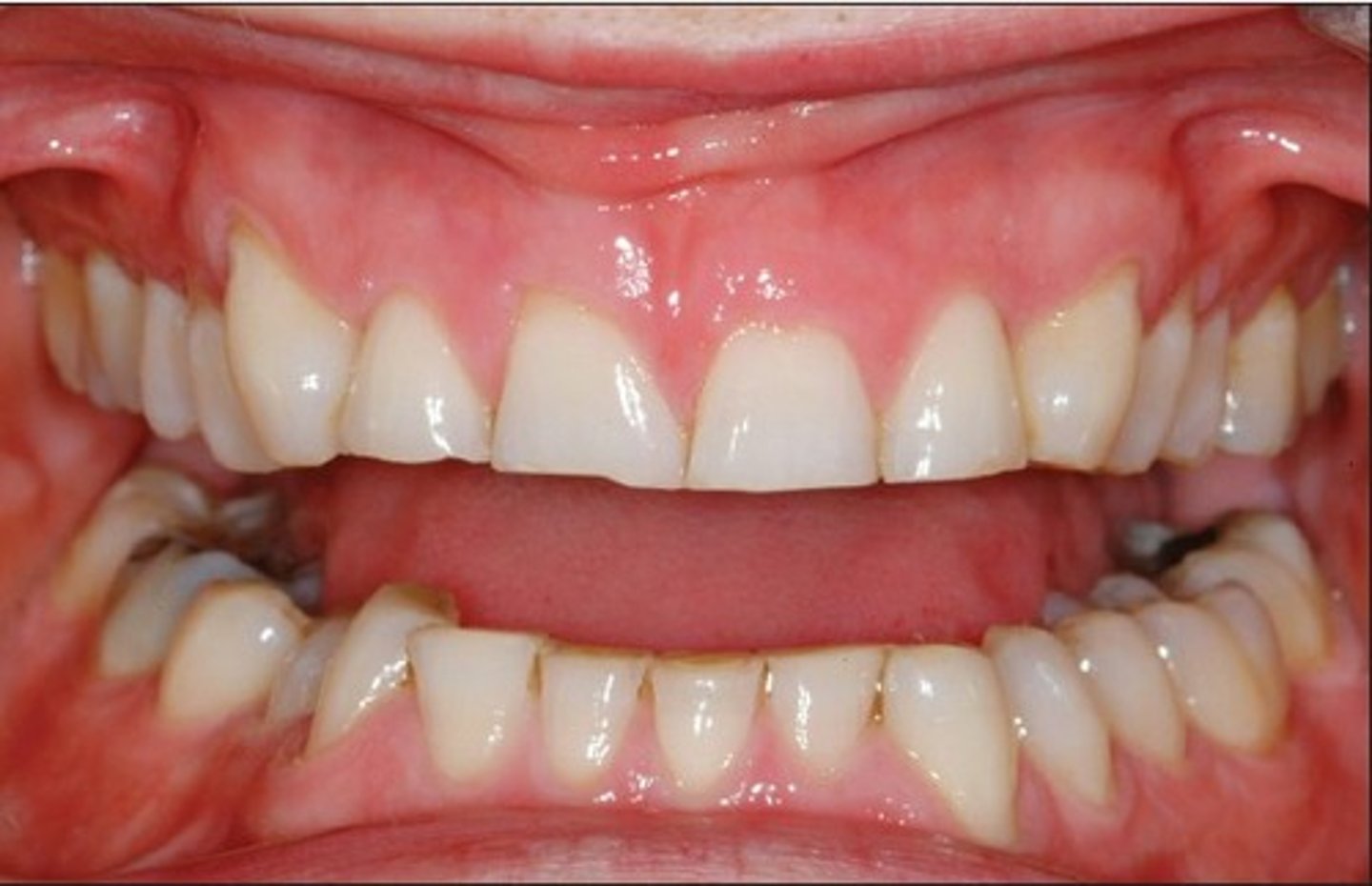 <p>Tooth wear caused by tooth-to-tooth contact:</p>