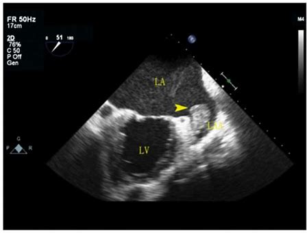 <p><span><span>What cardiac condition is demonstrated in this image?</span></span></p><p>LV Apical thrombus</p><p>LA appendage thrombus</p><p>LA myxoma</p>