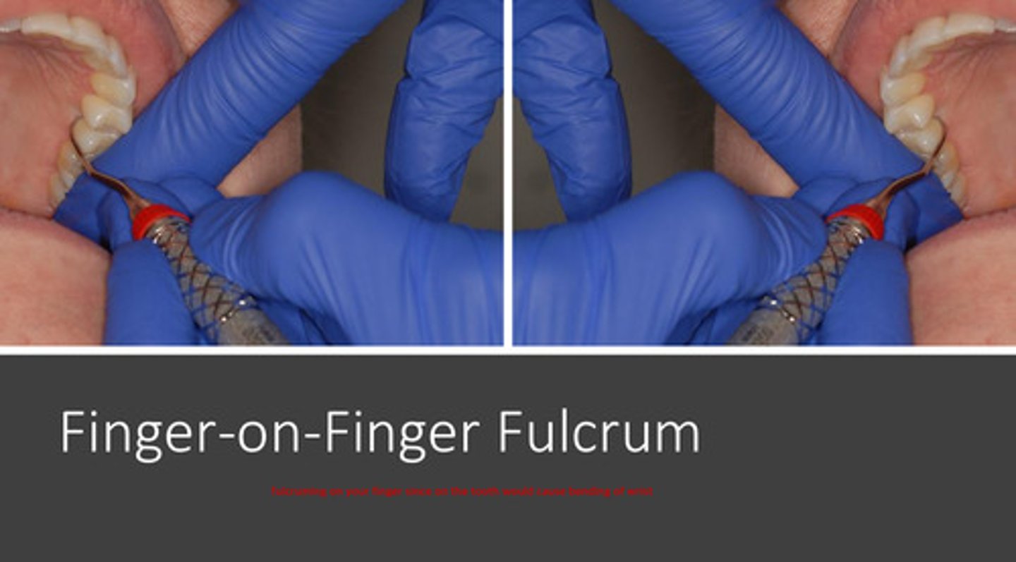 <p>finger of non-dominant hand serves as resting point for dominant hand, since fulcruming on the teeth itself may cause bending of the wrist (ie for lingual right posterior side)</p>