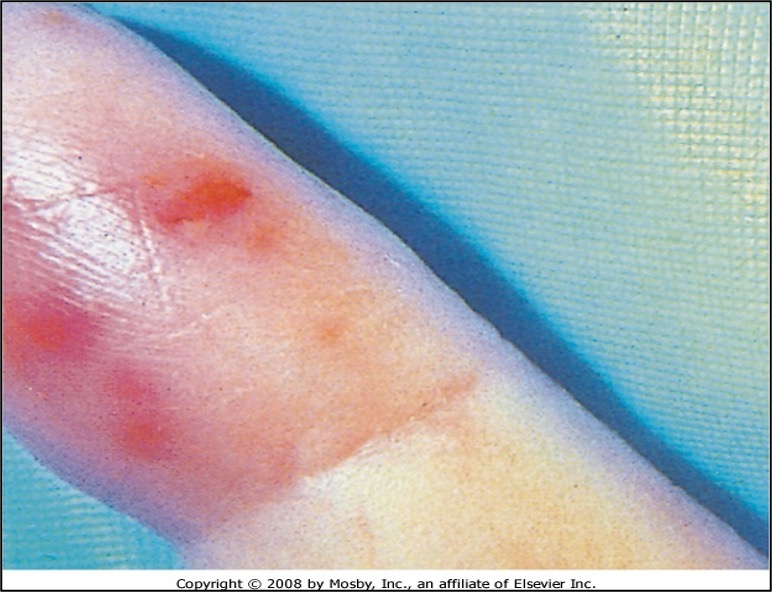 <p><strong>painful</strong> erythematous nodular lesions that result from infective endocarditis</p>