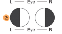 <p>Temporal vision of both the left and right eye</p>
