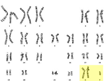 <p>Trisomy 23 </p>