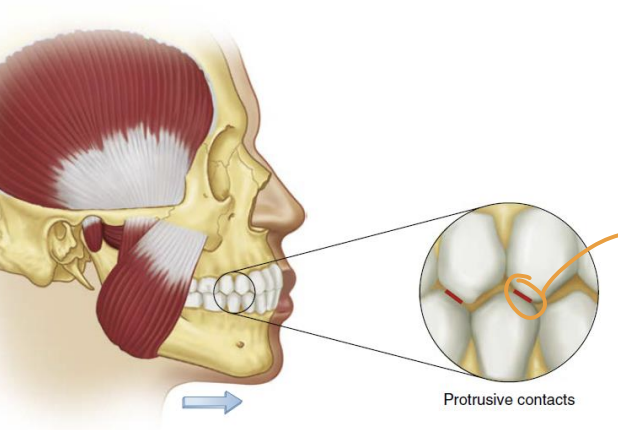 <p>mandible moves forward from intercuspal position</p>