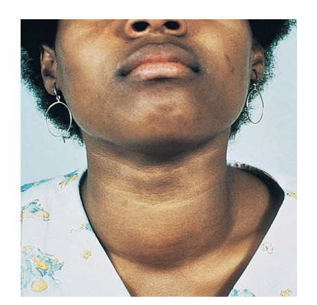 <p><strong><u>Clinical applications: Goiter</u></strong></p>