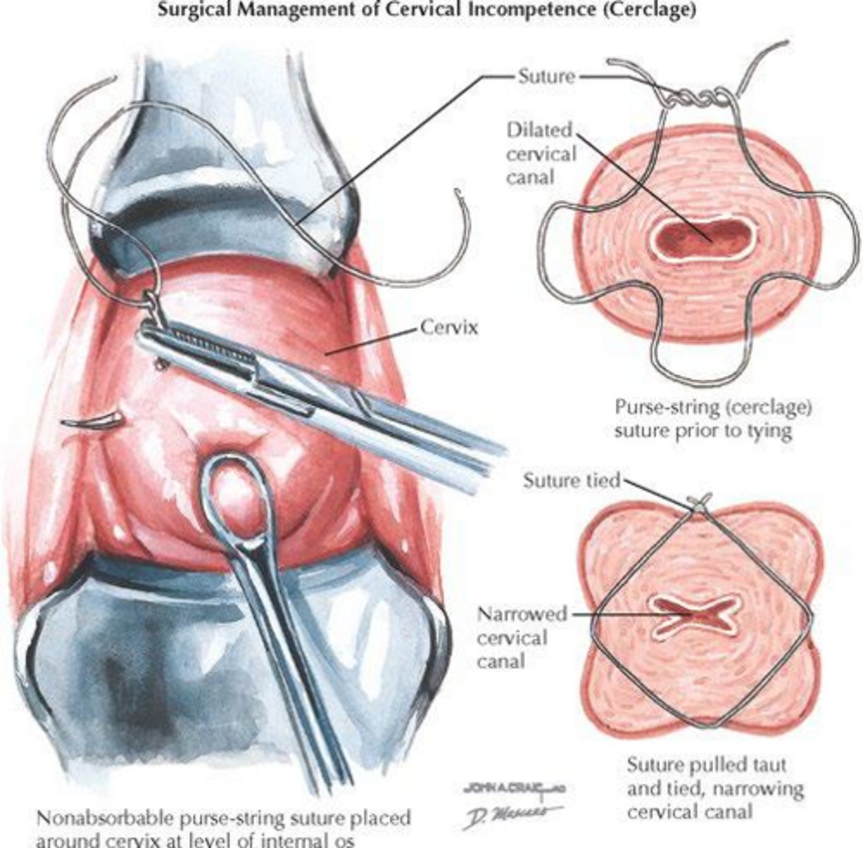 <p>Transabdominal or transvaginal cerclage.</p>