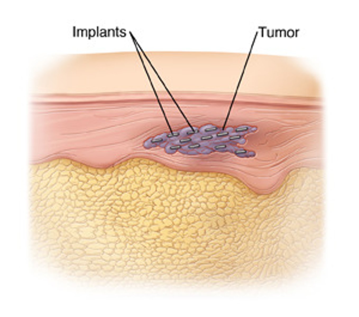 <p>the use of radioactive materials in contact with or implanted into the tissues to be treated</p>