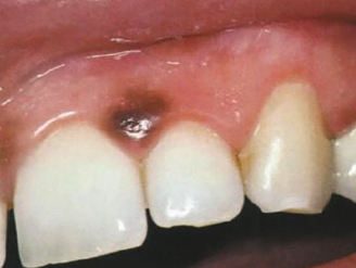 <p>When does acquired melanocytic nevus develop?</p>