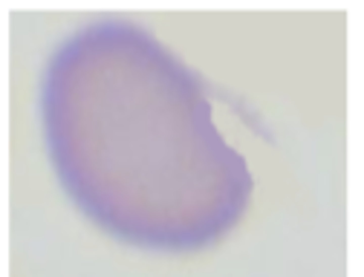 <p>blister splits leaving one projection</p>