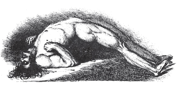 * Body injects endopores
* Caused by *Clostridium tetani*
  * Gram-positive, endospore-forming anaerobe 
* Grows in deep wounds, such as punctures 
* Bacteria release tetanospasmin (eg. step on rusty nail) , a potent neurotoxin that blocks the relaxation pathway in muscles, causing *spastic paralysis* (muscles are always contracted, you loose the ability to relax muscles) 
* Prevention by vaccination (DTaP) 
  * Tetanus immune globulin (TIG) is given to injured individuals whose vaccination history is unknown or out-of-date 

\
