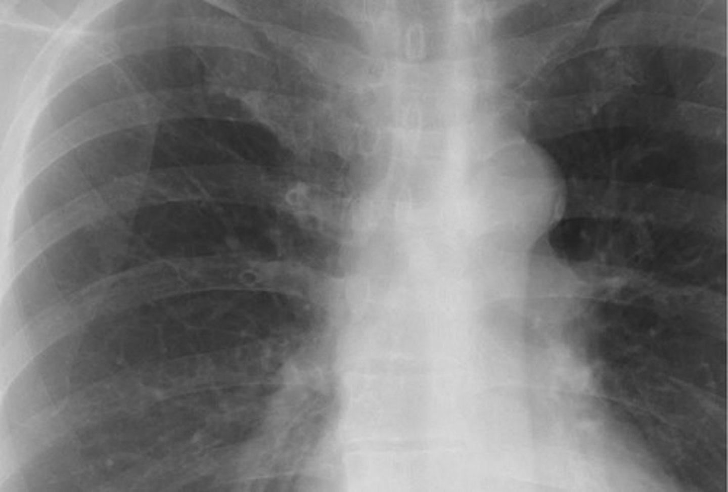 <p>peribronchial thickening (cuffing)</p>