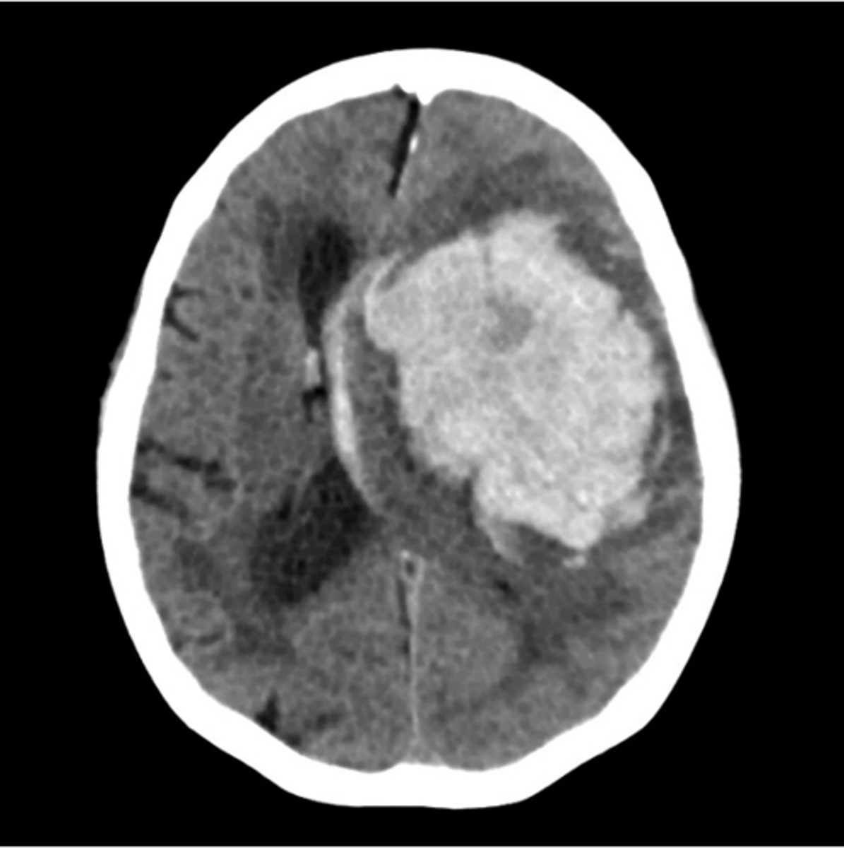 <p>typically not trauma related; can often come from a ruptured AVM from uncontrolled HTN</p>