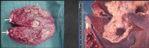 <p>Occurs when the parasite enters the circulatory system</p><ul><li><p>Most common extraintestinal form is the amoebic liver abscess</p></li><li><p>Characterized by right upper quadrant pain, weight loss, fever, and a tender and enlarged liver</p></li><li><p>Abscess found on the right lobe of the liver may penetrate the diaphragm and cause lung disease <strong>(Amoebic pneuomonitis)</strong></p></li><li><p>Other organs that may become infected include the pericardium, spleen, skin, and brain <strong>(Meningoencephalitis)</strong></p></li></ul><p></p>
