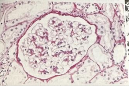 <p>A 6-year-old boy presents with periorbital edema two weeks after an upper respiratory infection. Labs show: albumin 1.9 g/dL, normal creatinine, normal complement, and urinalysis with 4+ protein. Kidney biopsy is normal by light microscopy, but electron microscopy shows diffuse effacement of foot processes. Which of the following is the best initial treatment?</p>