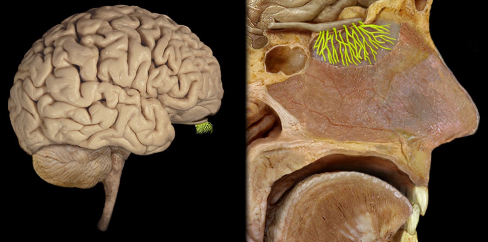 <h4 collapsed="false" seolevelmigrated="true"><strong>Location:</strong></h4><ul><li><p>Mucosa of anterosuperior nasal cavity (olfactory epithelium)</p></li><li><p>Anterior cranial fossa</p></li></ul><h4 collapsed="false" seolevelmigrated="true"><strong>Composition:</strong></h4><ul><li><p>Special sensation</p></li></ul><h4 collapsed="false" seolevelmigrated="true"><strong>Special sensation:</strong></h4><ul><li><p>Olfaction (smell)</p></li></ul><h4 collapsed="false" seolevelmigrated="true"><strong>CNS connection:</strong></h4><ul><li><p>Olfactory bulb</p></li></ul><h4 collapsed="false" seolevelmigrated="true"><strong>Cranial foramina:</strong></h4><ul><li><p>Cribriform plate of ethmoid bone</p></li></ul><h4 collapsed="false" seolevelmigrated="true"><strong>Comment:</strong></h4><ul><li><p>Special sensation includes smell, vision, taste, hearing, and balance</p></li><li><p>Olfactory nerve formed by proximal process (axons) of olfactory neurons</p></li><li><p>Olfactory axons project through cribriform plate to synapse in olfactory bulb</p></li><li><p>Olfactory nerve also known as CN I</p></li></ul>