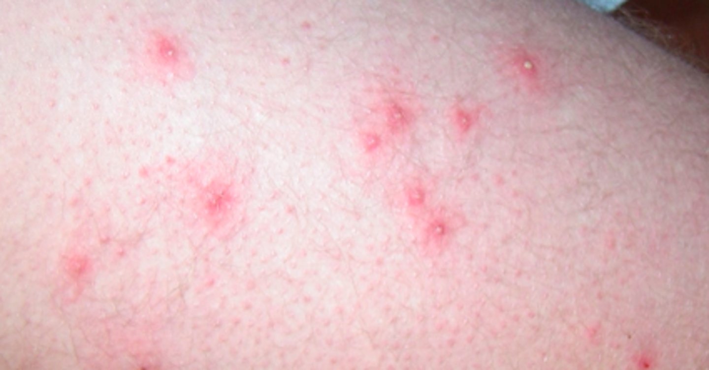 <p>Bacterial Skin Infections:</p><p>- bacterial infection that<strong> occurs in the upper part of the hair follicle</strong></p><p>- <strong>may extend deeper into the follicle if left untreated, may become chronic</strong></p><p>- shaving/waxing/plucking, and tight clothing are predisposing factors</p><p>- can be <strong>usually  non-tender</strong>; may be <strong>pruritic</strong></p><p>- will see multiple, small, <strong>erythematous follicular papules &amp; pustules scattered</strong> in areas of hair growth</p>