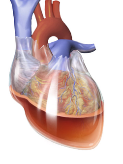 <p>Tamponade </p>