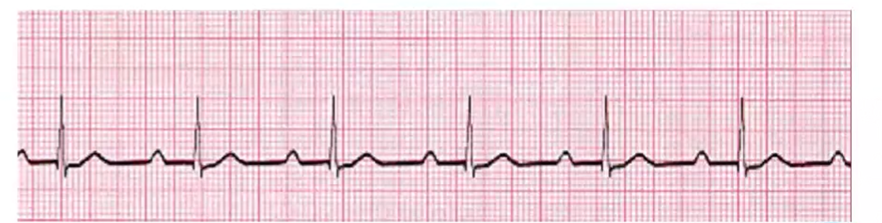 <p>What is a 2nd degree heart block or Mobitz type 1</p>