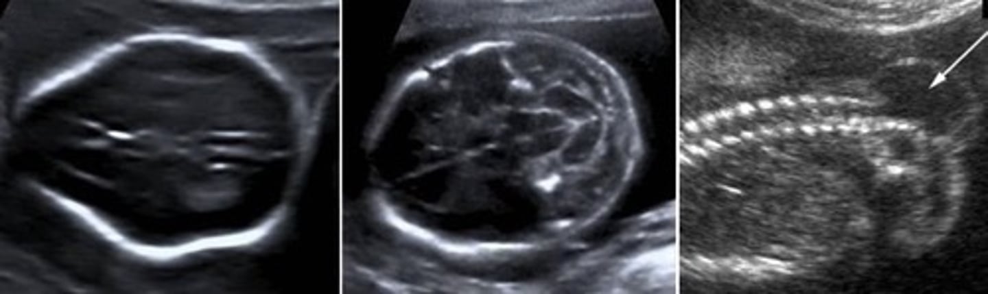 <p>Lemon-shaped head</p><p>Banana-shaped cerebellum</p><p>No cisterna magna</p><p>Mass protruding from spine</p>