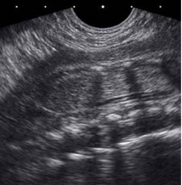 <p>what is seen on this coronal view of thoracic + lumbar spine</p><p>a) normal lung tissue</p><p>b) enlarged echogenic kidney</p><p>c) renal agenesis</p><p>d) abn splaying of vertebral bodies</p>
