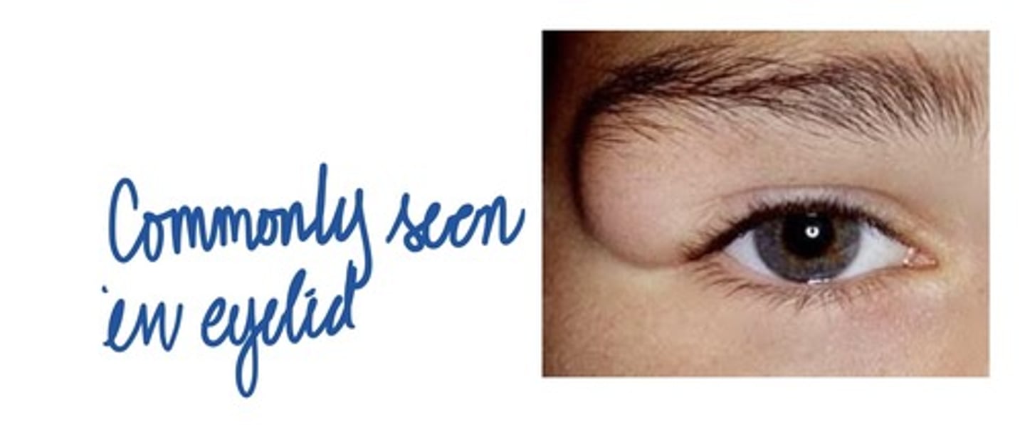<p>A developmental cyst often present at birth or noted in young children. Usually found on the floor of the mouth when it is located in the oral cavity. May cause tongue displacement. May have a doughy consistency when palpated.</p>
