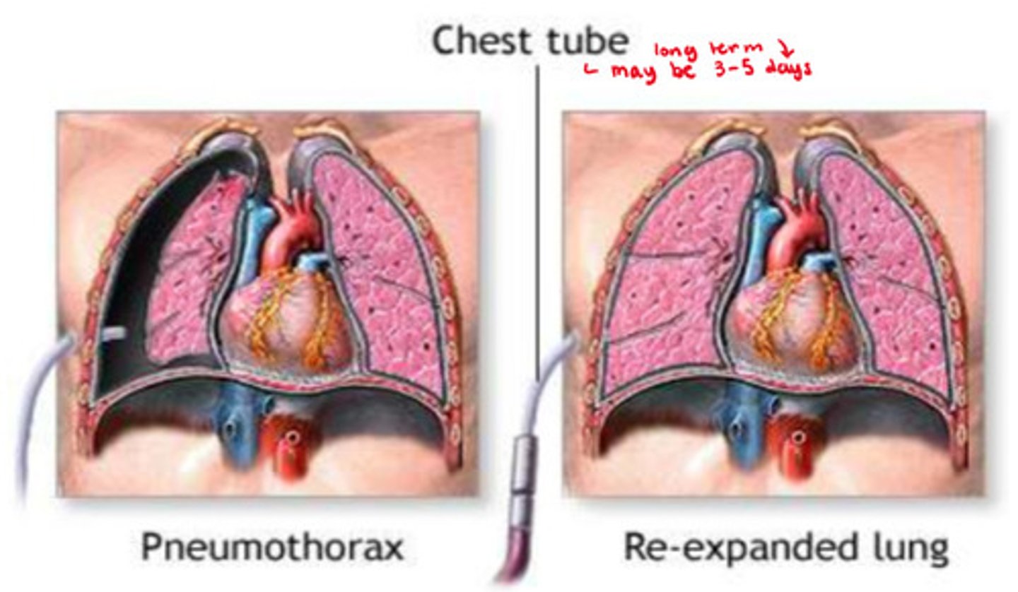 <p>- injury to the chest wall causes air to enter the pleural space but not to exit it</p><p>=> increase in pressure within the pleural space, compresses the lungs, causes lung collapse (always a medical emergency)</p>